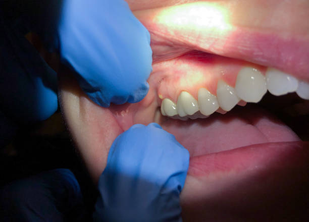 Best Emergency Care for Gum Disease in Germantown, WI